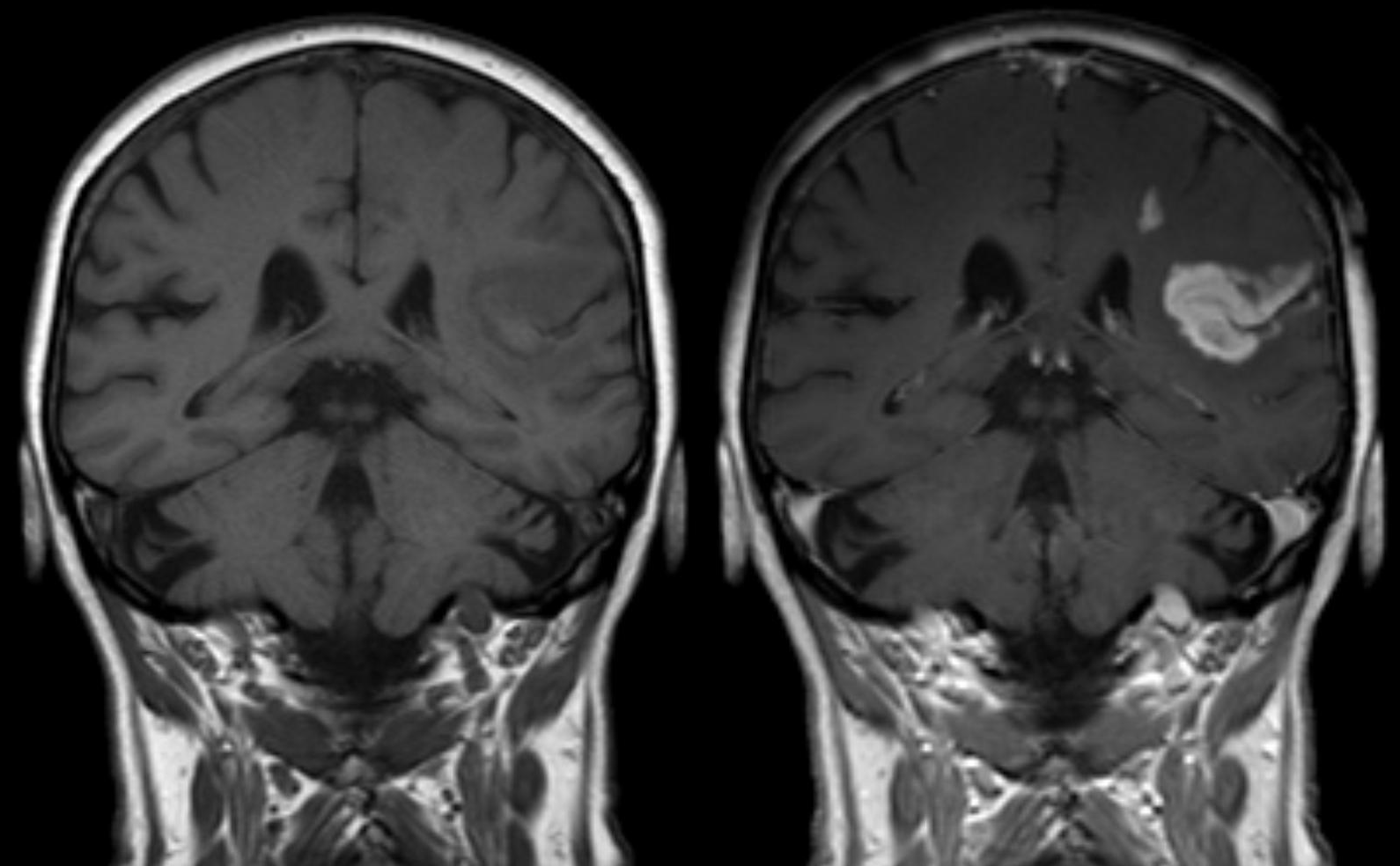 New NCAA Concussion Study