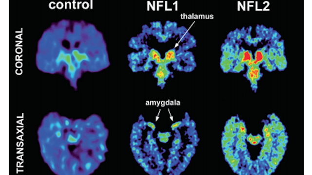 NFL Concussion Study